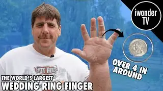 Jeff Dabe Has The World's Largest Wedding Ring Finger