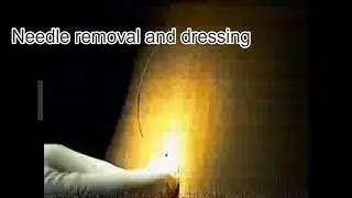Early training for epidural block technique (two stages spinal block).