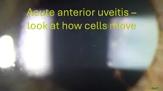 0046: Acute anterior uveitis - look at how the cells move!