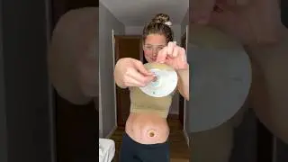 Its called an Ileostomy&hellip; google it ✌🏼 #ostomy #shorts #ostomate #ileostomy #stoma #medical