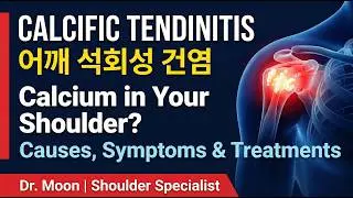 Calcific Tendinitis of the Shoulder: Causes, Symptoms, and Effective Treatments