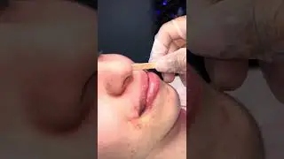 Hair removal upper lip with hard wax  #waxing #hairremoval #youtubeshorts #fyp #facialhair #beauty