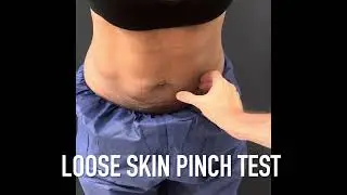 Renuvion skin tightening . Snatched waist.Call 202-621-8675. Dr Drew Varano Medical Cosmetic Wash DC