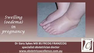 Swelling  (oedema) in pregnancy