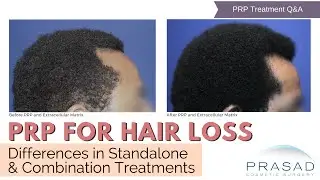 PRP Treatment for Hair Loss - Differences in Standalone and Combination Treatments