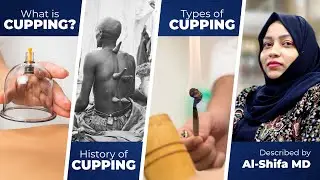 The History of Cupping Therapy | Alshifa Cupping Clinic