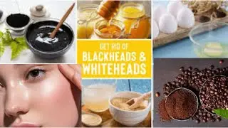 Easy Ways To Remove Blackheads And Whiteheads At Home By RADIANT Sparkle #RadiantSparkle,#clearskin