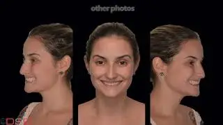Facetas e Laminados Cer&acirc;micos no fluxo digital