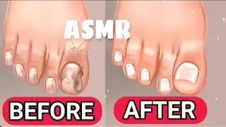 ASMR Ingrown toenail removal Relaxing with Nails Cleaning Satisfying treatment