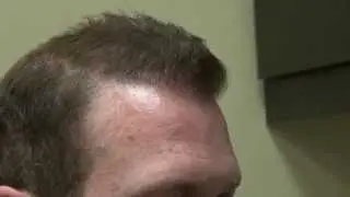 Bald Hair Loss Receding Hairline Transplant Treatment Dr. Diep  
