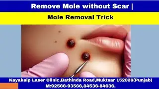 Remove Mole without Scar | Mole Removal Trick | #Moleremoval