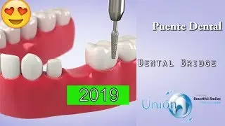 😁 Dental Bridge | Restorative Dentistry | Price, Cost | Tijuana, Mexico | 2019