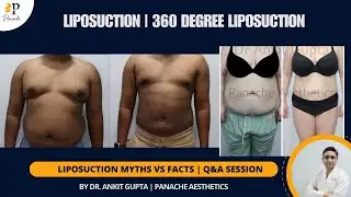 Tummy Liposuction for Fat Removal | 360 Degree Liposuction Before & After | Fat Loss Surgery