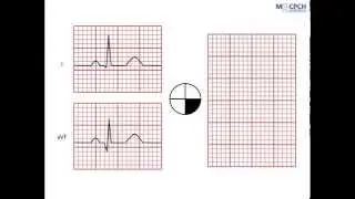 Working out the QRS axis on an ECG