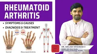 Rheumatoid Arthritis Simplified | Dr. Abilash Krishnan V | Docemy 💜