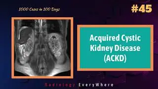 Acquired Cystic Kidney Disease ACKD | Radiology tutorials | video 45