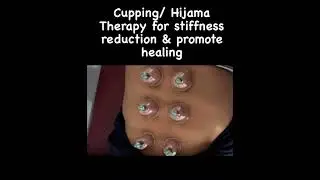 Cupping therapy #cupping #cuppingtherapy #physiotherapy #shortfeed #trendingshorts #drvidhikaushik