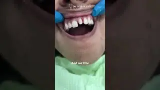 Transform Your Smile with Expert Capping Work at Dr. Sowmya's Dental Care | Chennai Dentist
