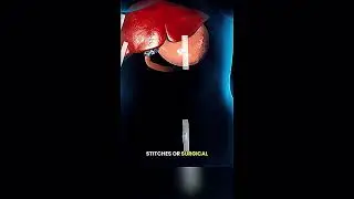 Cholecystectomy Surgery Visualized - The Camera, The Instruments, The Results