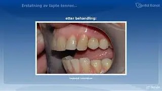 Implantater | Implantatkirurgi - Tanntunet Tannhelsesenter