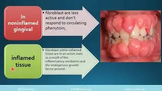 gingival enlargement with audio explanation