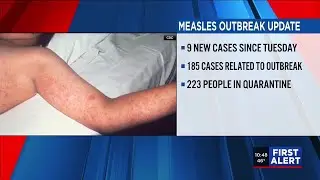 Measles outbreak update in Upstate