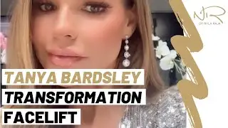 Tanya Bardsley - Dr Nyla Raja's Transformation Facelift 😍