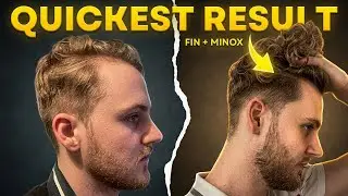 Finasteride and Minoxidil for Quickest Hair Growth Results!
