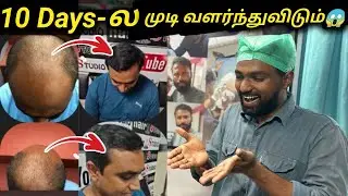 10 Days-ல முடி வளர்ந்துவிடும்😱 | Hair Loss Solution | PRP,GFC - treatment Tamil | vimals lifestyle