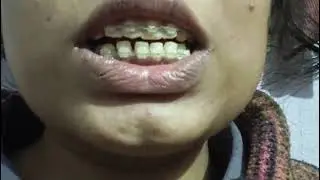 Braces experience#braces ;!!🥰#dentist #dentalbraces #smiledesigndental #dentalcare #youtubeindia 