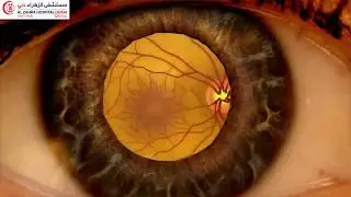 Diabetes can cause damage to the blood vessels of the retina - Ophthalmology Al Zahra Hospital Dubai