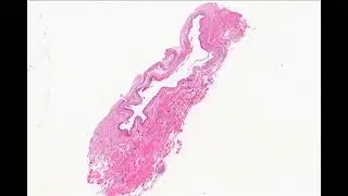 Apocrine Hidrocystoma Ocular Pathology