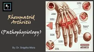 Rheumatoid Arthritis: How The Immune System Destroys Joints.