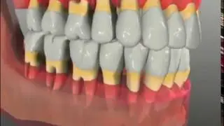Dentist Dr. Chris Stevens - Periodontal Disease - Sun Prairie, WI