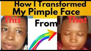 How I Transformed My Pimples Face into Clear, Pimples - Free  Skin( No Filter).