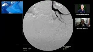 TruSelect&trade; Microcatheter Live Case Recording