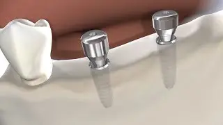 Benefits of Dental Implants in Springfield IL | Oral & Facial Surgeons of Illinois