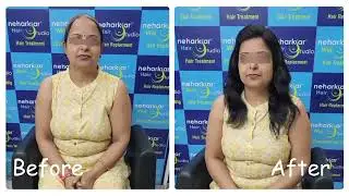 Customized Hair Wigs for Cancer Patients |Customized Hair Wigs for Cancer Patients in Mumbai |