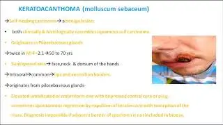 ORALPATH -CHAP2 -PART2- BENIGN AND MALIGNANT TUMOURS- ENGLISH