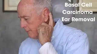 Basal Cell Carcinoma Ear Removal: Patient Testimonial Part 1