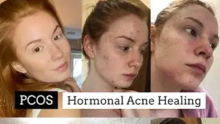 How I healed my PCOS Hormonal Acne Naturally || No Accutane *Planet Friendly Skincare Routine