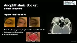 Understanding and Managing Biofil Associated  Infections in Oculoplastic Practice