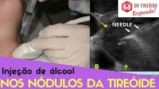 🔴  Ablação de nódulos na tireóide com álcool - Dr Tireóide Responde #18#