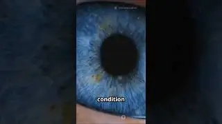 The Rare condition in Human Eye |#shorts #trending #viral #shortsfeed #ytshorts