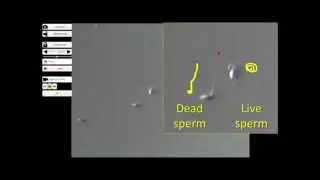 Laser-assisted immotile sperm selection (LAISS)