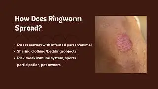 Ringworm