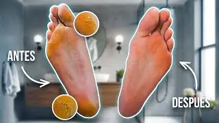 C&oacute;mo Quitar La Resequedad Y Los Callos En Los Pies