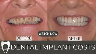 Dental Implant Costs in London: Shocking Truth Revealed