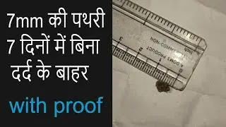 7mm की पथरी 7 दिनों में बिना दर्द के बाहर kidney stones medicine EduTrix | AshokKumar