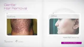 Laser Hair Removal in Jacksonville, Florida - Hello Smooth Laser Studio